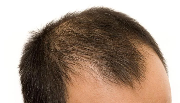 Hair Loss or Male-Pattern Baldness
